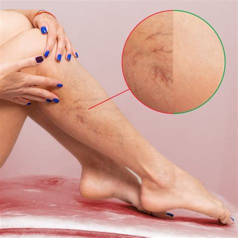 Symptoms of Venous Insufficiency - Delaware Vein Center