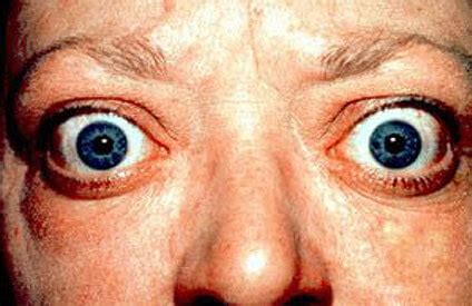 Graves’ Ophthalmopathy: Symptoms, Diagnosis and Treatments - Houston Advanced Sinus