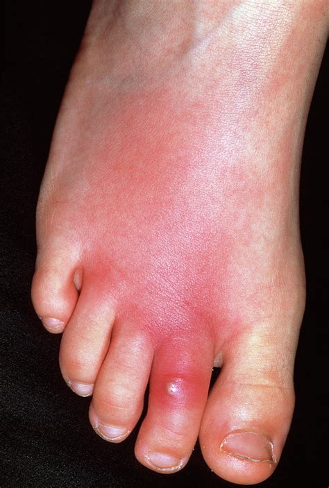 Cellulitis On Top Of Foot