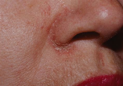 seborrheic dermatitis on nose - pictures, photos