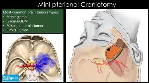 Minimally Invasive Brain Surgery | Keyhole Craniotomy | Pacific Brain ...