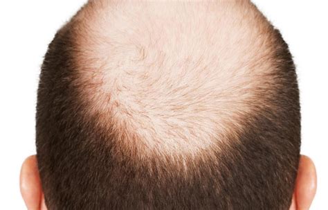 Male Pattern Baldness Stages