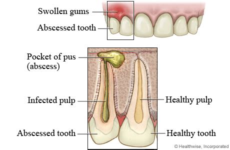 Dental abscess