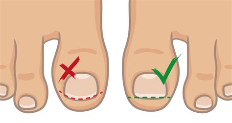 Black Toenail - Symptoms, Causes, Treatment & Prevention