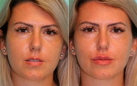 Lip Augmentation photos | Chevy Chase, MD | Patient 15747