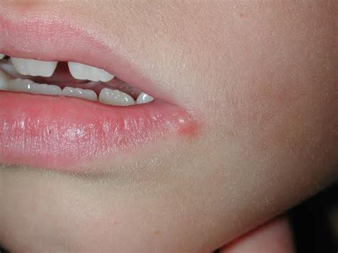 Herpes Around Lips Symptoms - Infoupdate.org