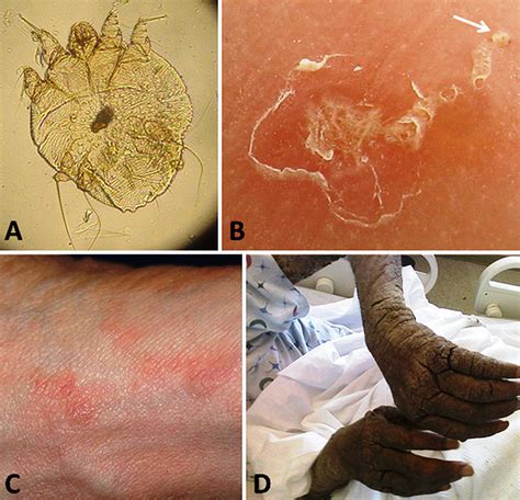 Scabies - Encyclopedia of Arkansas