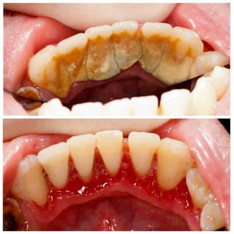 Teeth Cleaning Before and After - Teeth FAQ Blog