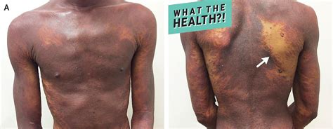 This Man Went to the Doctor for a Rash and It Turned Out He Had HIV | Health.com