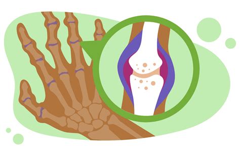 The Complete Guide To Becoming A Rheumatology Doctor | BMJ Careers