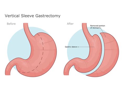 Gastric Sleeve in the Midlands | Allure Weight Loss