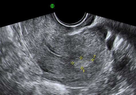 Chapter 6 – Endometrial polyps – Melaka Fertility