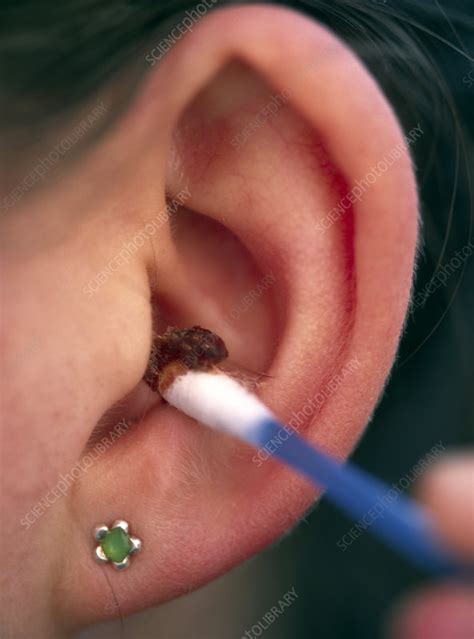 Ear canal cleaning - Stock Image - M985/0174 - Science Photo Library