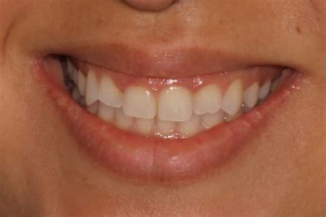 Gum Lift Before & After Photos | Samadian Cosmetic & Advanced Dentistry