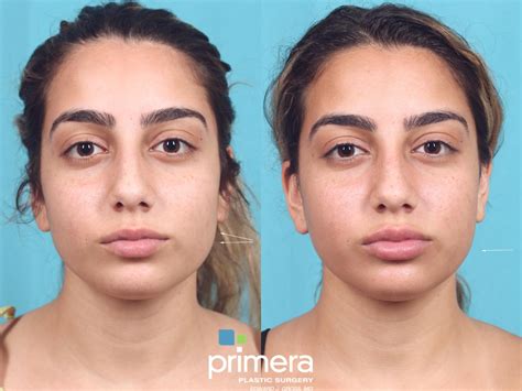 BOTOX® Cosmetic Before and After Pictures Case 743 | Orlando, Florida | Primera Plastic Surgery