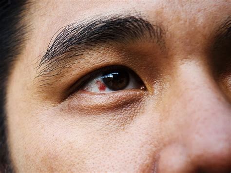 Burst blood vessel in the eye: Causes and treatment - Medical News Today