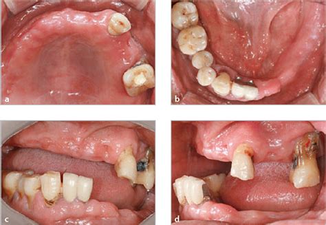 Restoration of a partially edentulous patient with an implant-supported ...