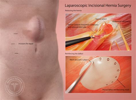 Incisional Hernia Repair near Pasadena and Los Angeles CA