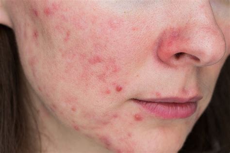 Bacterial Folliculitis On Face