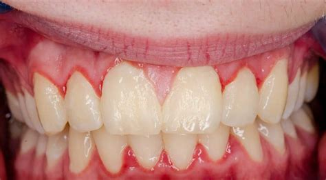 Gingivitis Before And After Treatment