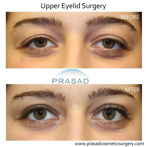 What Causes Heavy Lidded Eyes and How to Treat Them