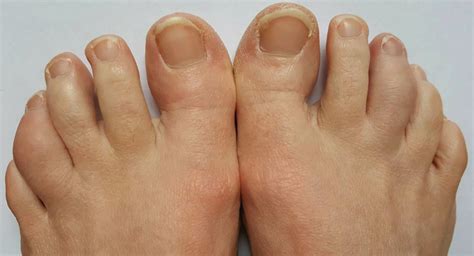 Psoriatic Arthritis Toes