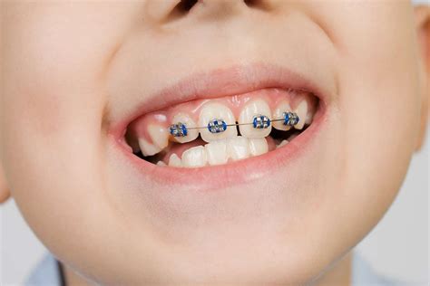 Pediatric Dentistry Category Archives | Splendid Dental Woodlands