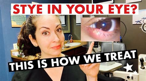 STYES! | What are they and how are they treated? | The Eye Surgeon - YouTube