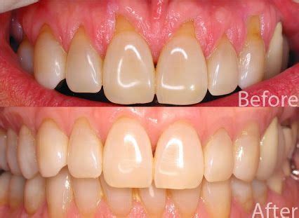 Receding Gums Stages