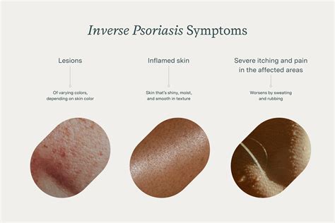 What Is Inverse Psoriasis? Symptoms, Stages, & Management