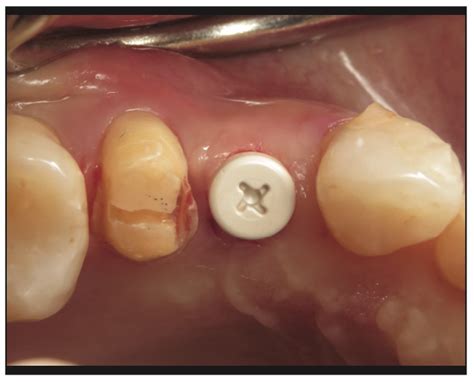 Ceramic Implants and Dental Implant Rehabilitation, Part I - Dentistry Today