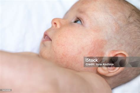 A Baby Boy Face With Red Irritated Skin On Left Cheek Dermatitis Stock Photo - Download Image ...