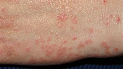 Scabies Burrows After Treatment