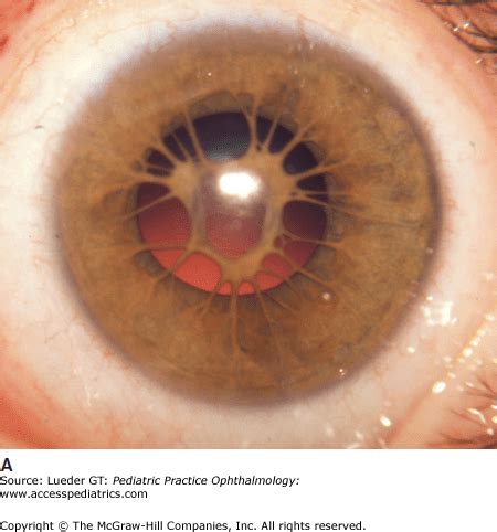 Disorders of the Iris and Pupil | Ento Key