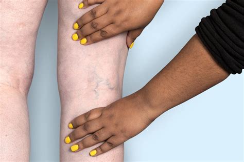 What Your Blue, Green, or Purple Veins Are Telling You | Metro Vein Centers