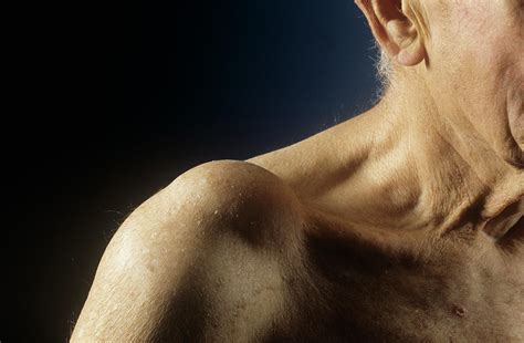 Shoulder Joint Cyst Photograph by Mike Devlin/science Photo Library - Pixels Merch