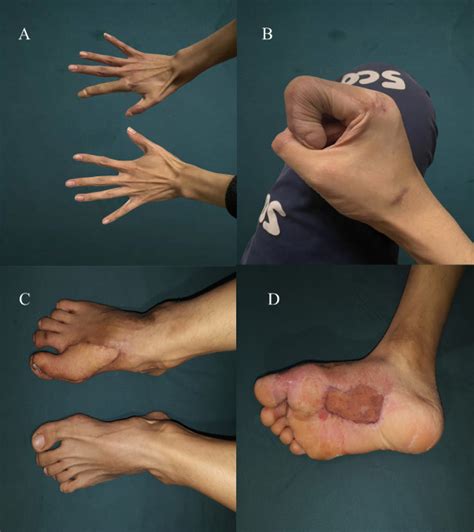 Combined great toe dorsal nail-skin flap and medial plantar flap for one-stage reconstruction of ...