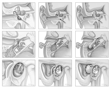 Ear Tumor Anatomy – Oto Surgery Atlas