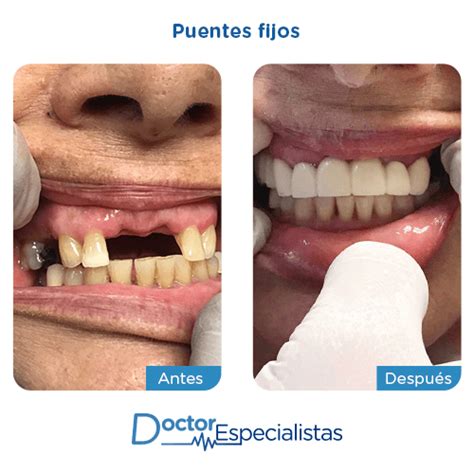 Preparaciones Puente Fijo Y Provisional Anterior ?Parte1, 48% OFF