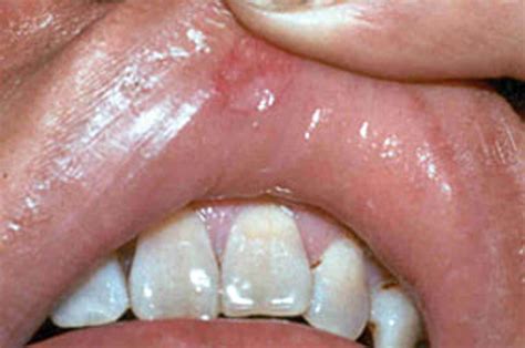 Pictures Of Syphilis Sores On The Lips | Lipstutorial.org