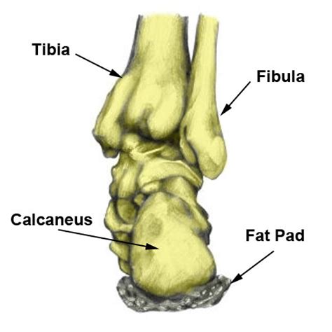 Calcaneal Stress Fracture - Symptoms, Causes & Treatment