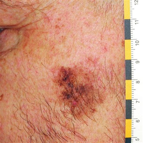 Patient at increased risk for cutaneous melanoma with history of... | Download Scientific Diagram