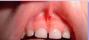 Labial Frenulum