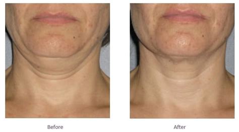 How to get rid of Neck Fat, lose neck fat | Non-surgical Fat Neck ...