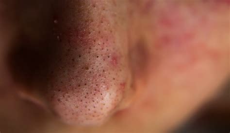 Blackheads: What They Look Like, Treatment & Prevention