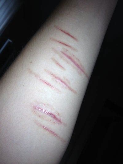 I Need Advice on my Arm?Cutting Scars? (photo) Doctor Answers, Tips