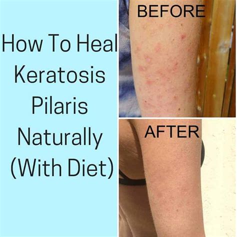 The Link Between Diet and Keratosis Pilaris: What to Eat and Avoid - Ask The Nurse Expert