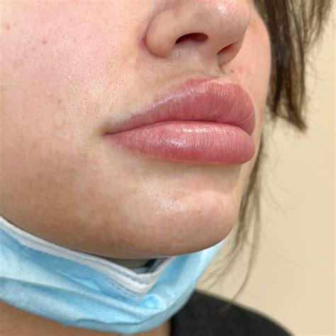 Lip Filler Dissolving at BooshTOX - BooshTOX