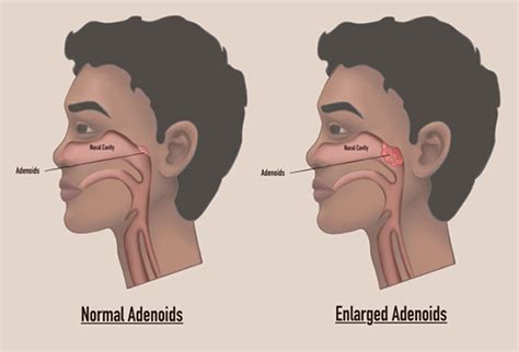 Tonsillectomy & Adenotonsillectomy | KidsHealth NZ