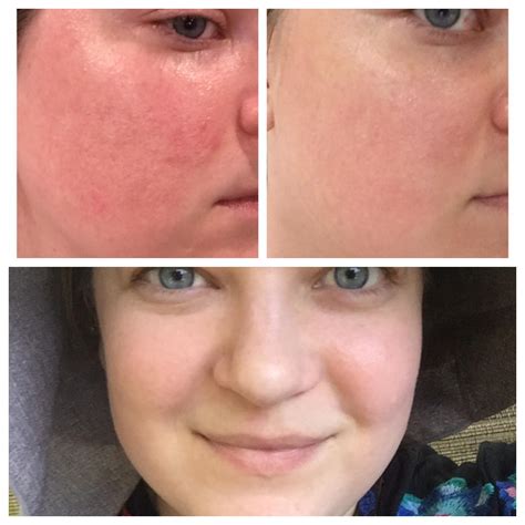 Rosacea Before And After